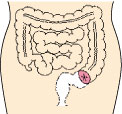 上行結腸ストーマ